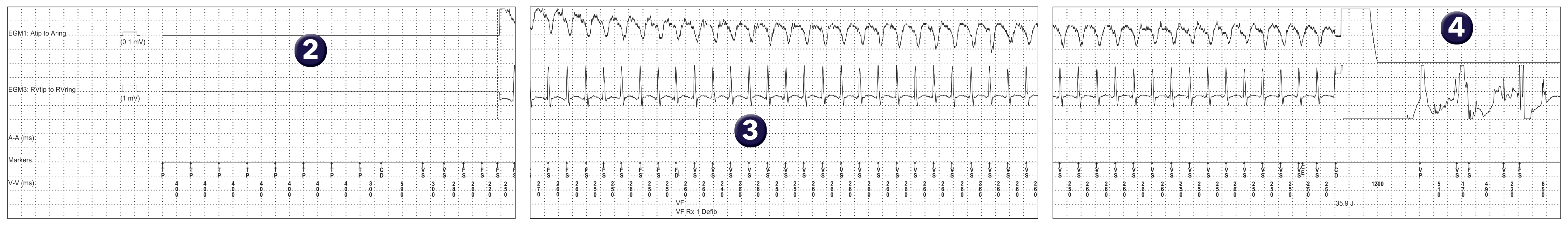 Medtronic ICD electrogram, segment 1 of 1 — The benefits of induction at the end of implantation