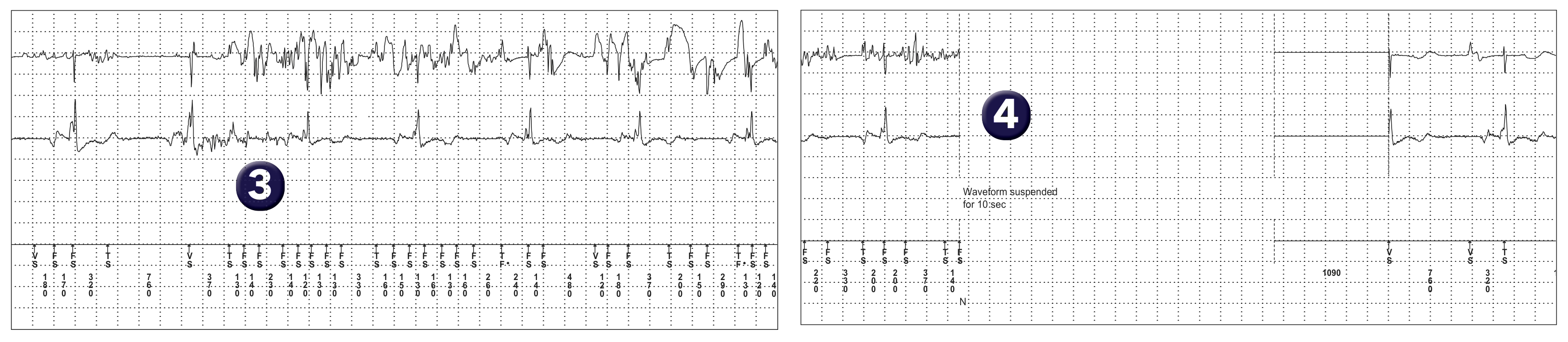 Medtronic ICD electrogram, segment 1 of 1 — Use of an algorithm to avoid inappropriate therapies