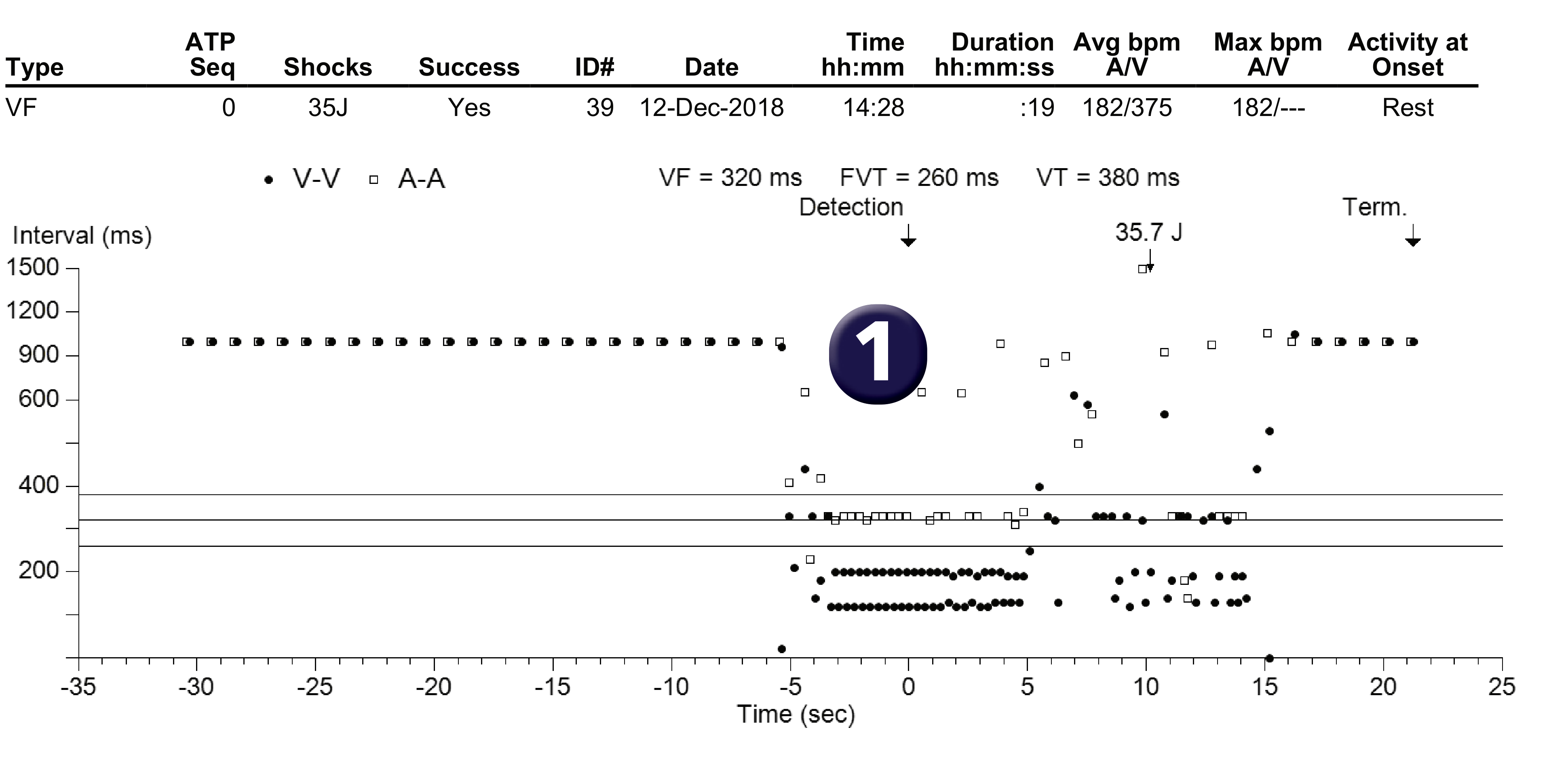 Medtronic ICD electrogram, segment 1 of 1 — A characteristic feature on the EGM