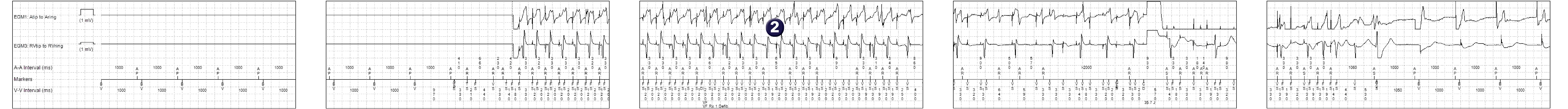 Medtronic ICD electrogram, segment 1 of 1 — A characteristic feature on the EGM
