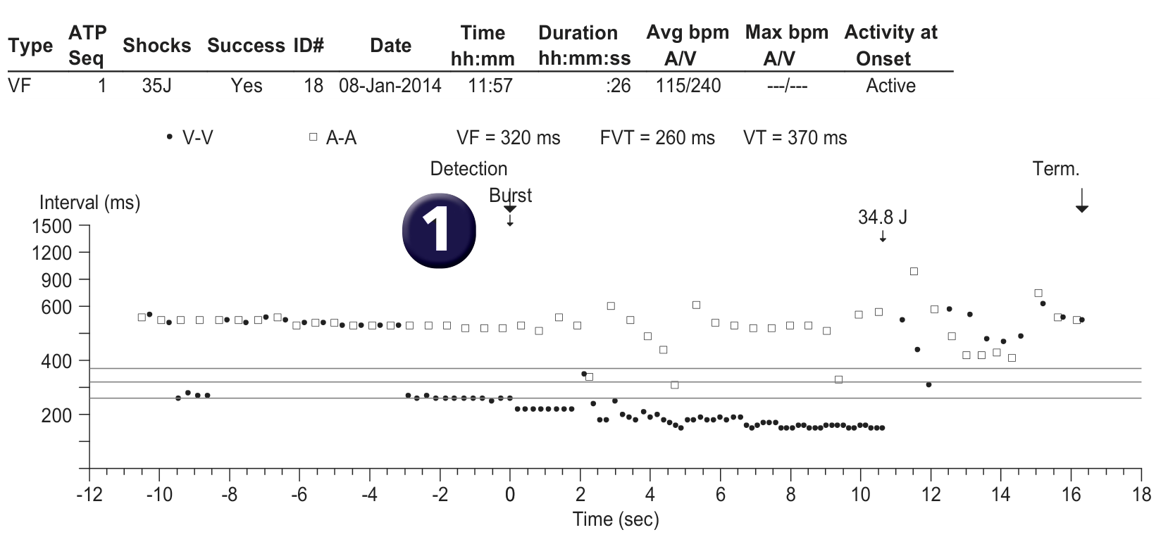 Medtronic ICD electrogram, segment 1 of 1 — Oversensing and risk of sudden death