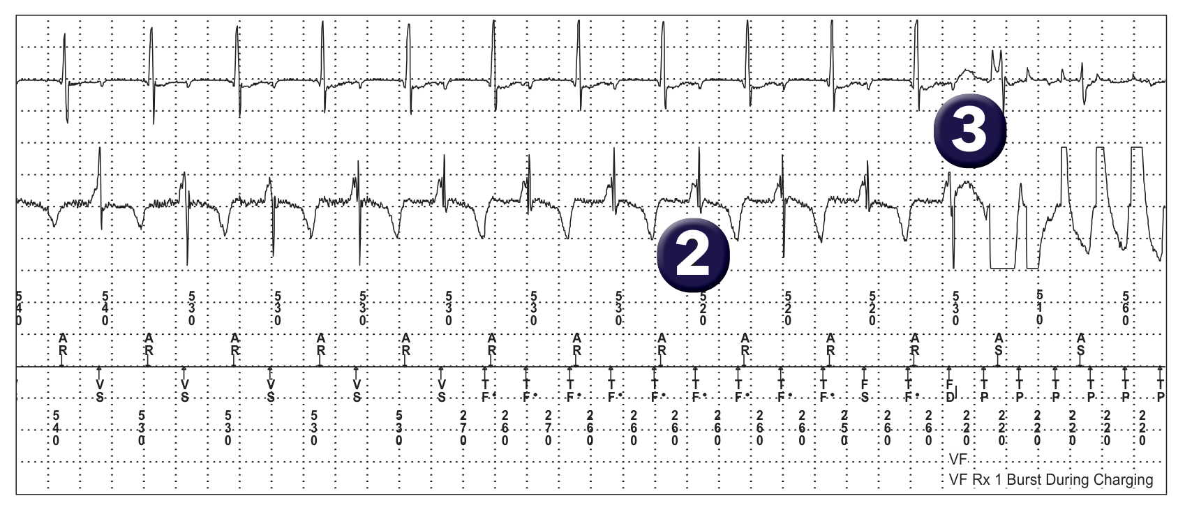 Medtronic ICD electrogram, segment 1 of 3 — Oversensing and risk of sudden death