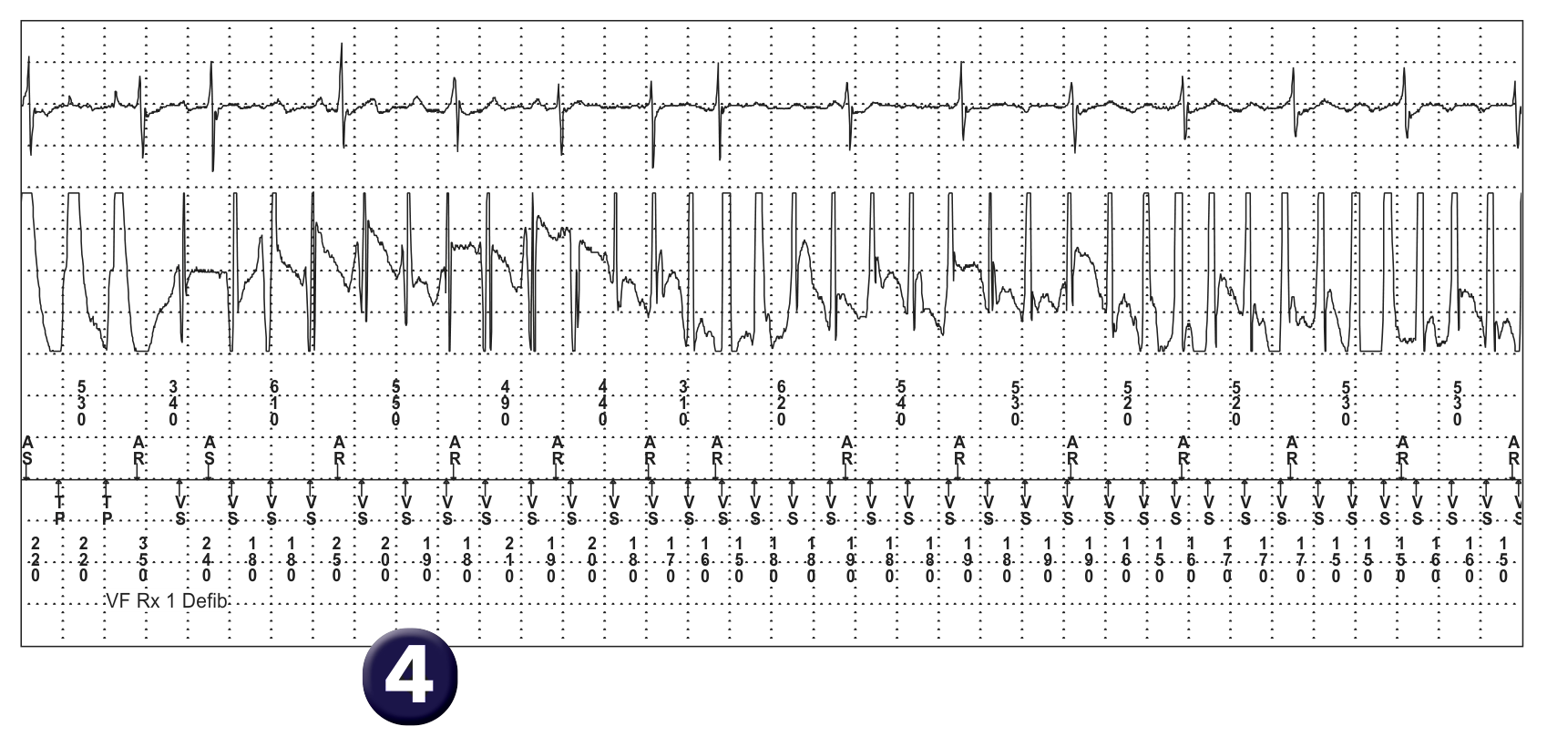 Medtronic ICD electrogram, segment 2 of 3 — Oversensing and risk of sudden death