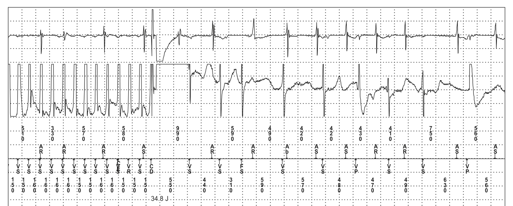 Medtronic ICD electrogram, segment 3 of 3 — Oversensing and risk of sudden death