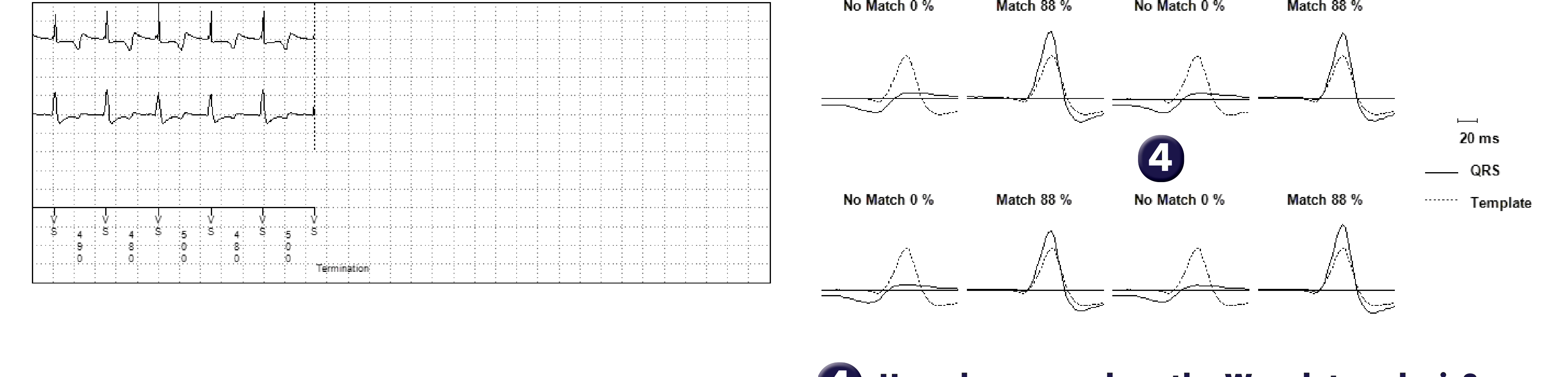 Medtronic ICD electrogram, segment 2 of 2 — Use of a specific algorithm