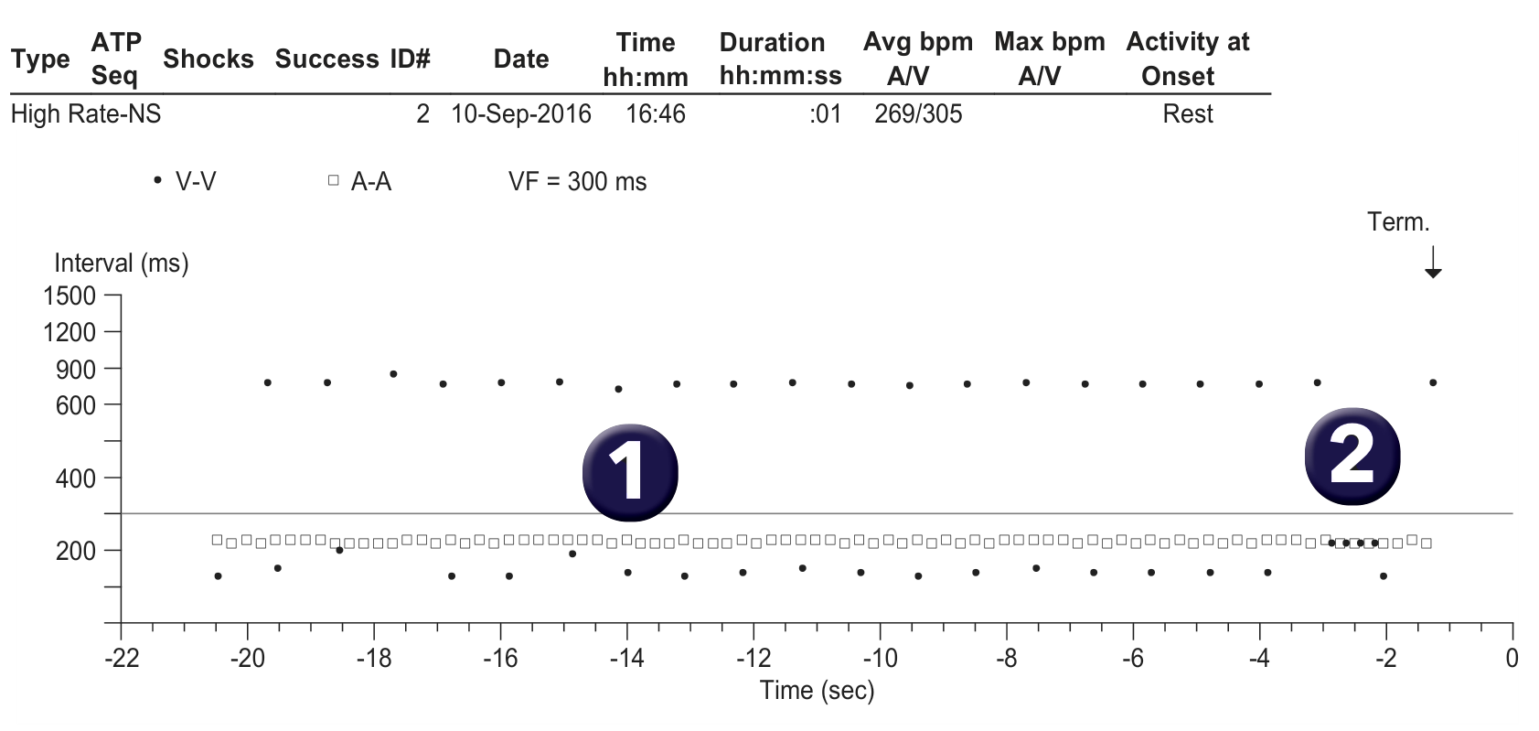 Medtronic ICD electrogram, segment 1 of 1 — Oversensing and integrated bipolar mode