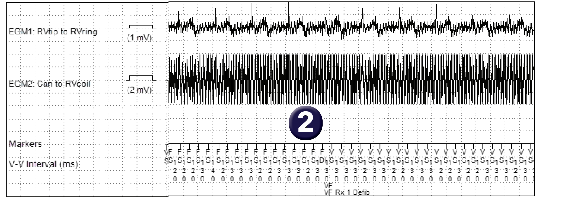 Medtronic ICD electrogram, segment 1 of 1 — Electric shock during a barbecue