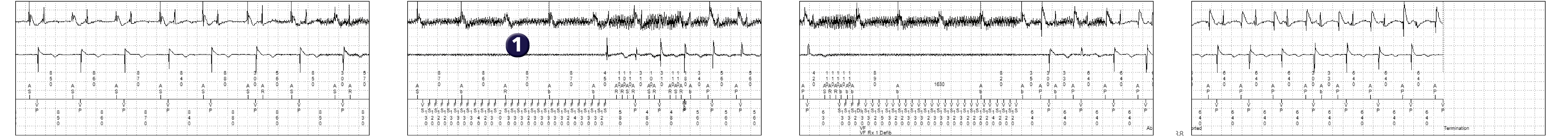 Medtronic ICD electrogram, segment 1 of 2 — An unexpected cause of syncope