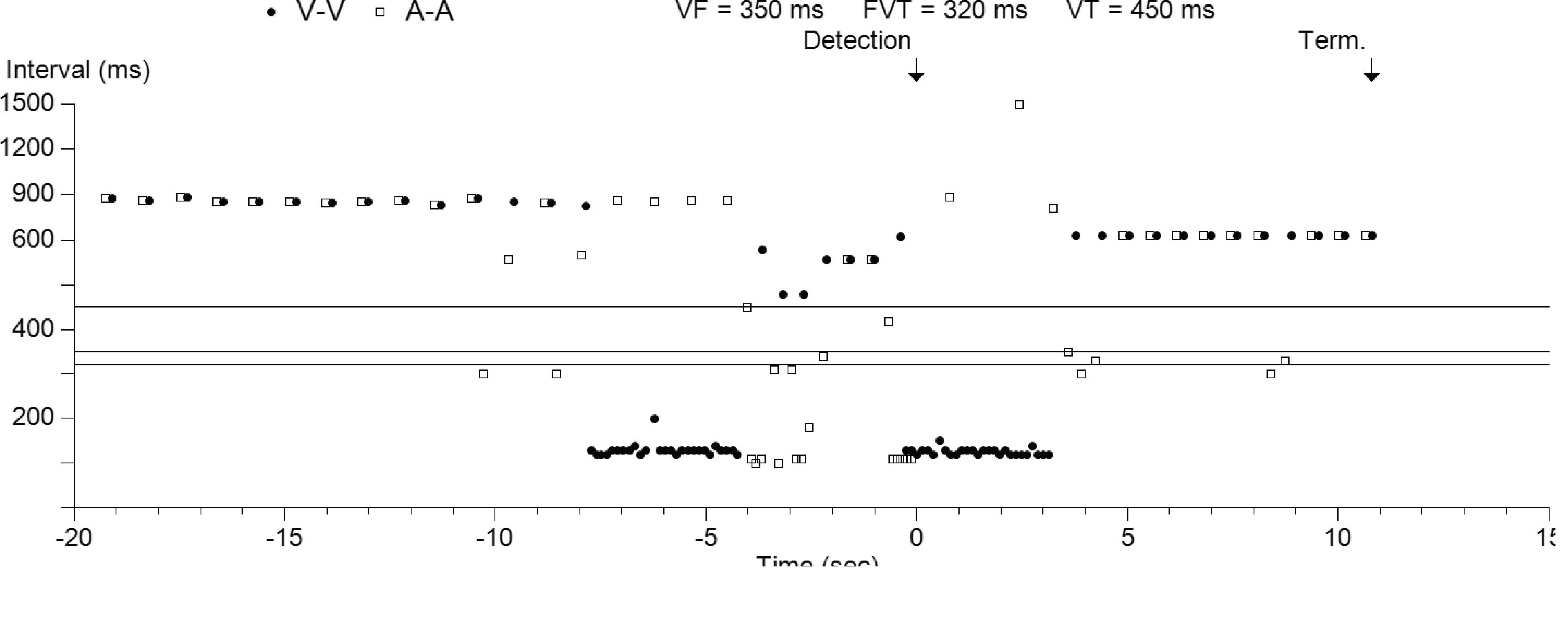 Medtronic ICD electrogram, segment 1 of 1 — An unexpected cause of syncope