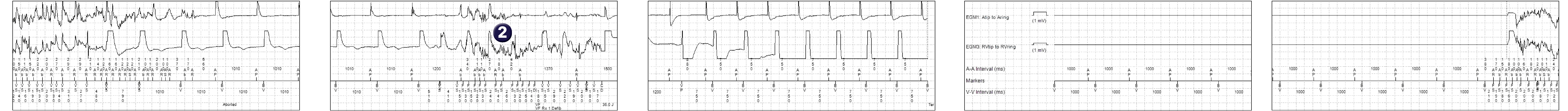 Medtronic ICD electrogram, segment 1 of 2 — Shock during surgery