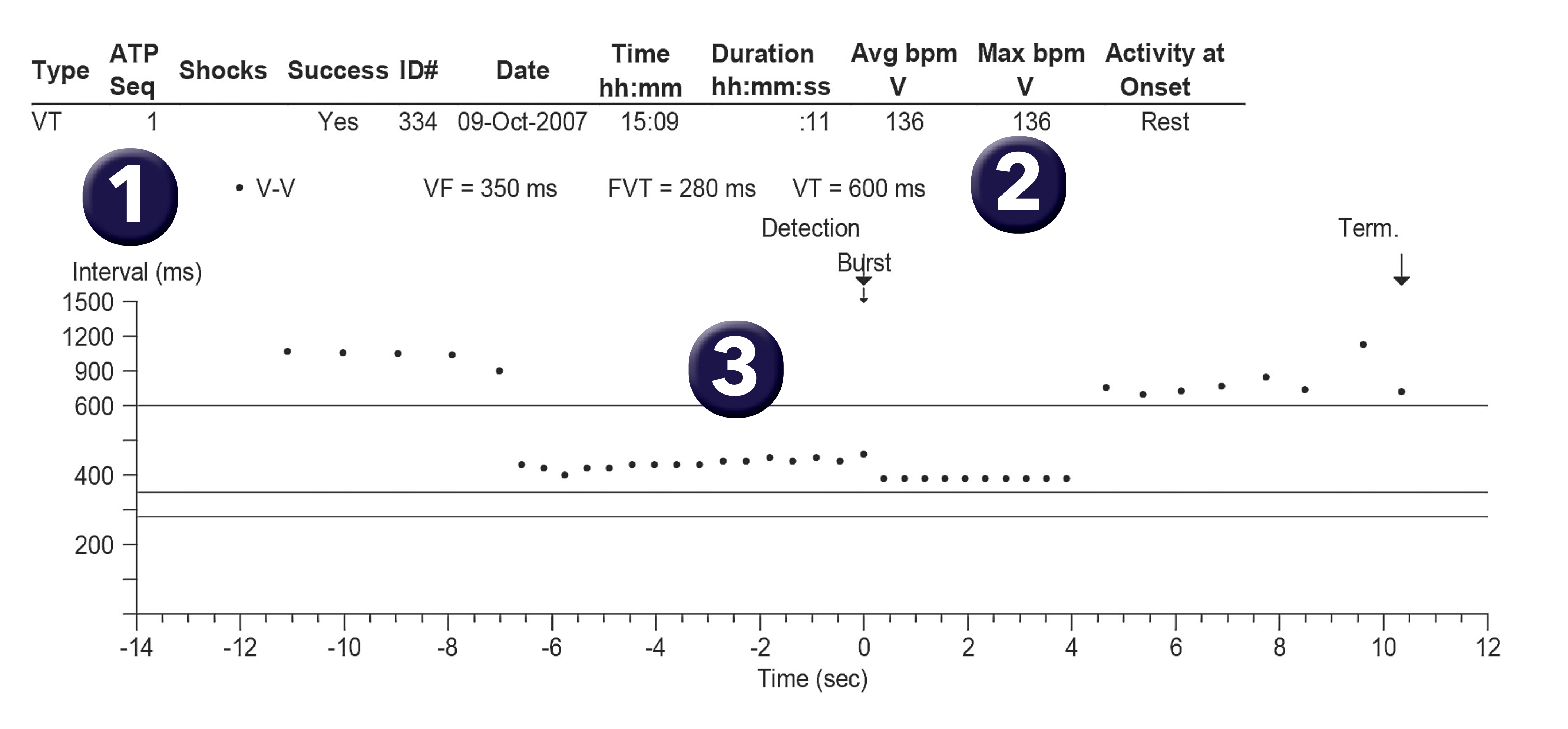 Medtronic ICD electrogram, segment 1 of 1 — Discriminators available on a single-chamber defibrillator