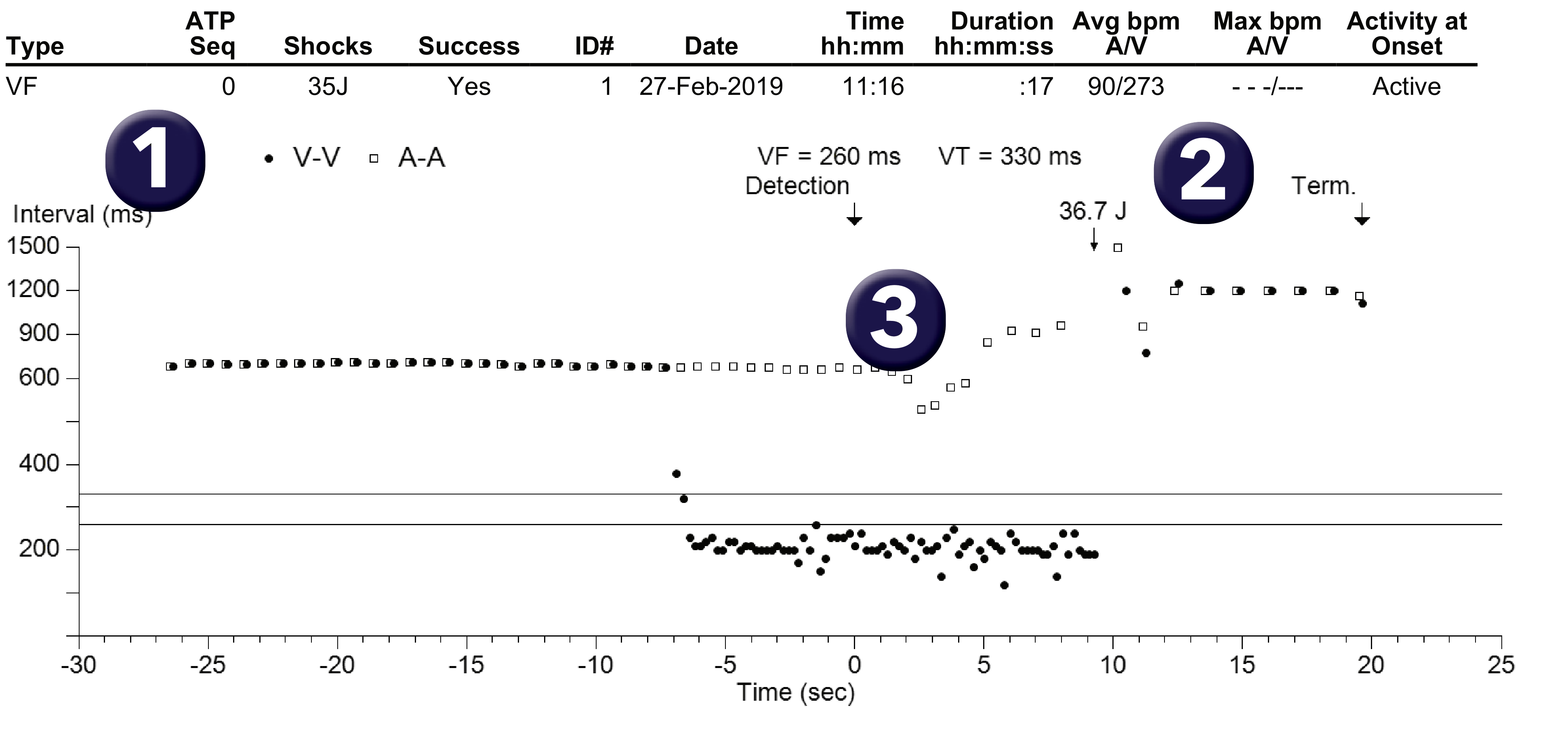Medtronic ICD electrogram, segment 1 of 1 — Triple-chamber defibrillator and V limit. SVT