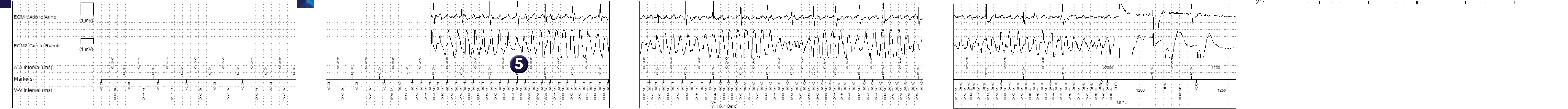 Medtronic ICD electrogram, segment 1 of 1 — Triple-chamber defibrillator and V limit. SVT