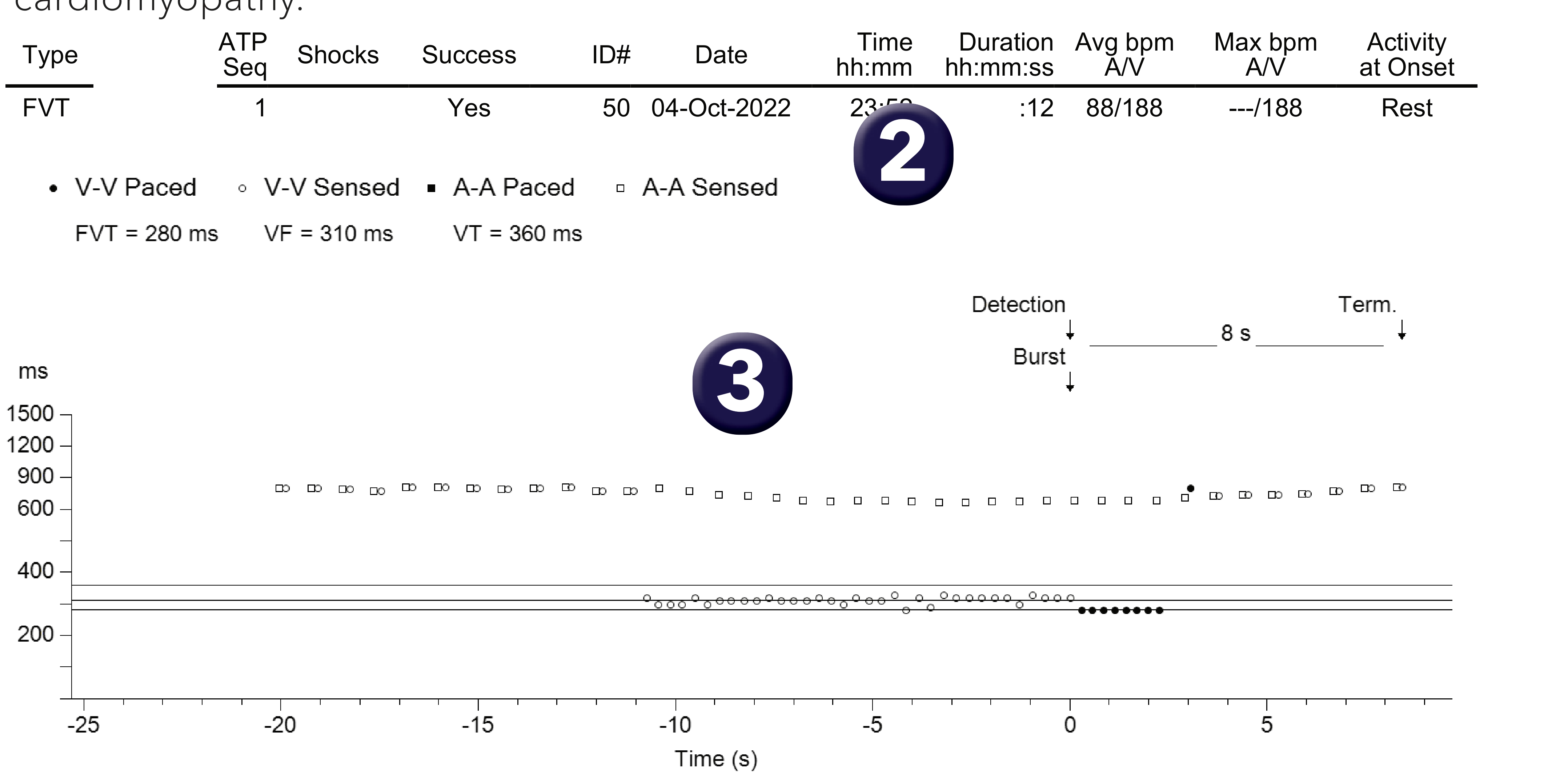 Medtronic ICD electrogram, segment 1 of 1 — Dual-chamber defibrillator and atrioventricular dissociation