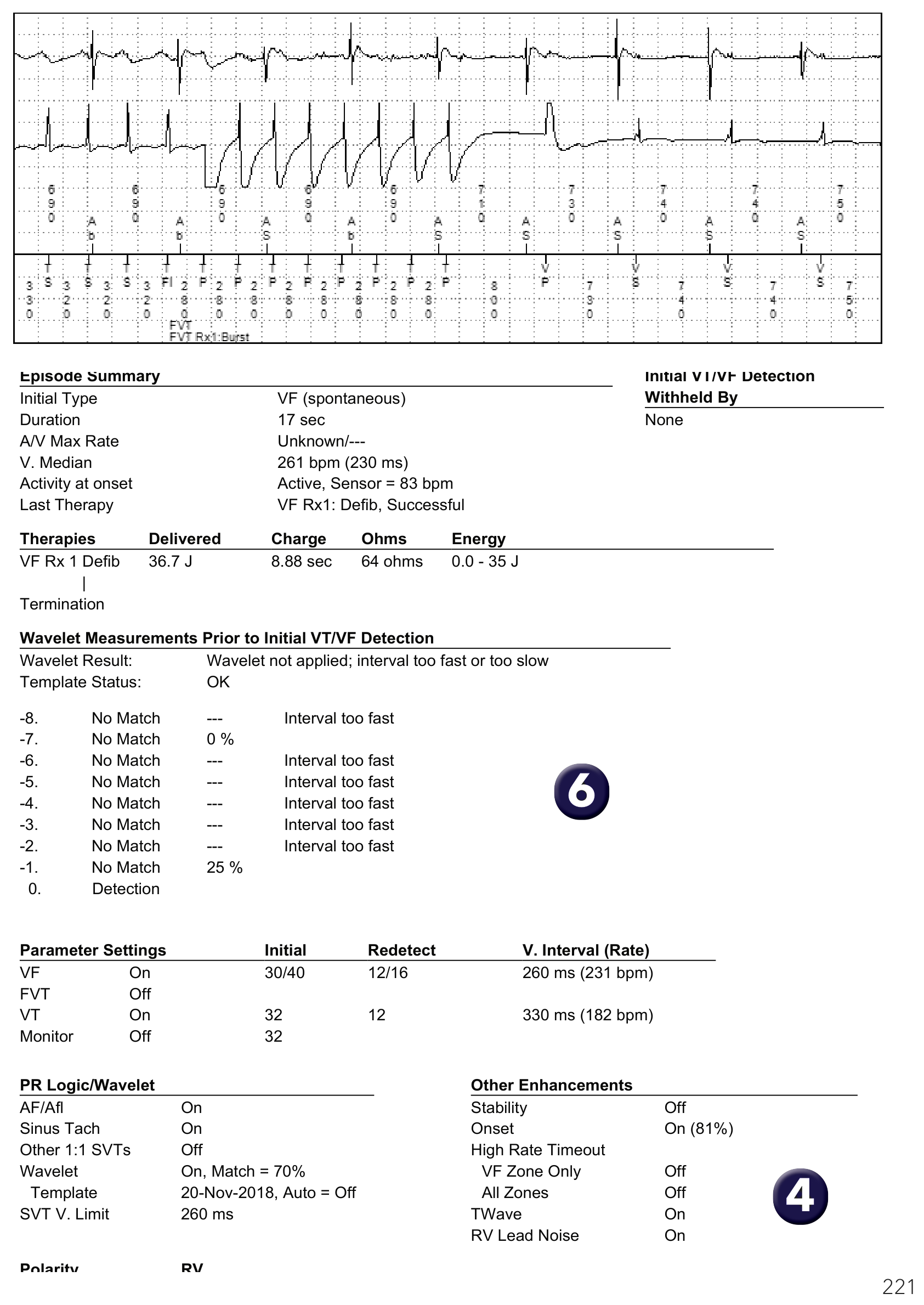 Medtronic ICD electrogram, segment 1 of 1 — Dual-chamber defibrillator and atrioventricular dissociation