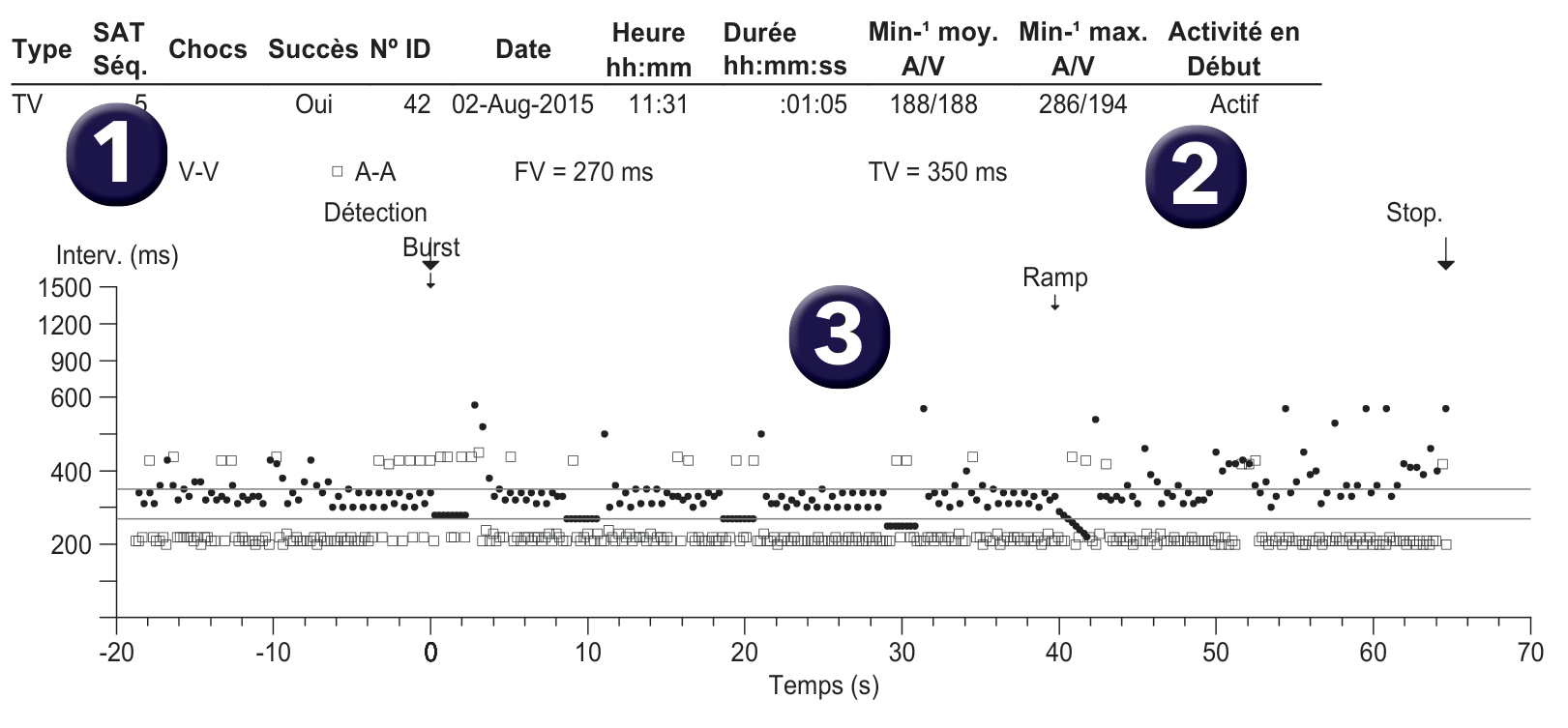 Medtronic ICD electrogram, segment 1 of 1 — Dual-chamber discrimination and atrial detection