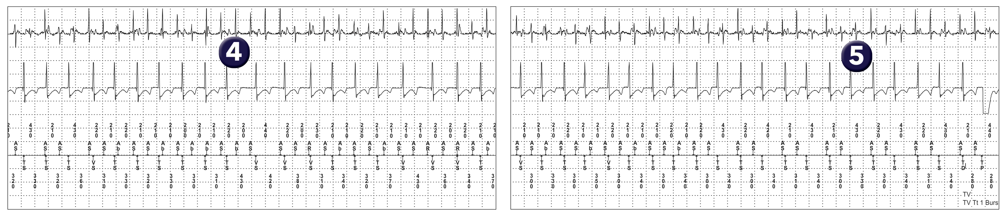 Medtronic ICD electrogram, segment 1 of 4 — Dual-chamber discrimination and atrial detection