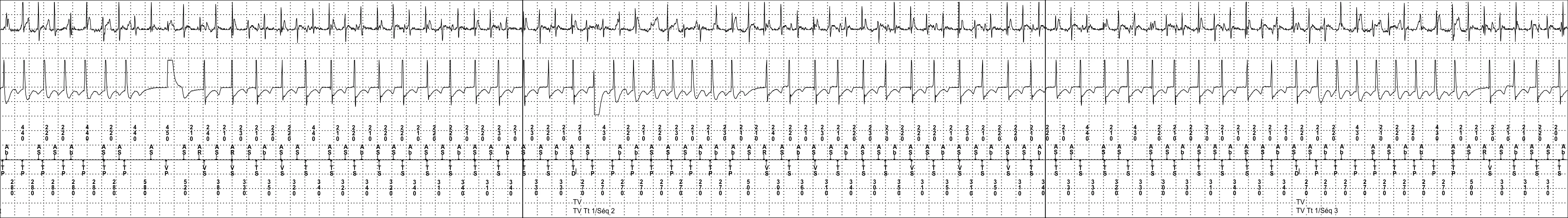 Medtronic ICD electrogram, segment 2 of 4 — Dual-chamber discrimination and atrial detection