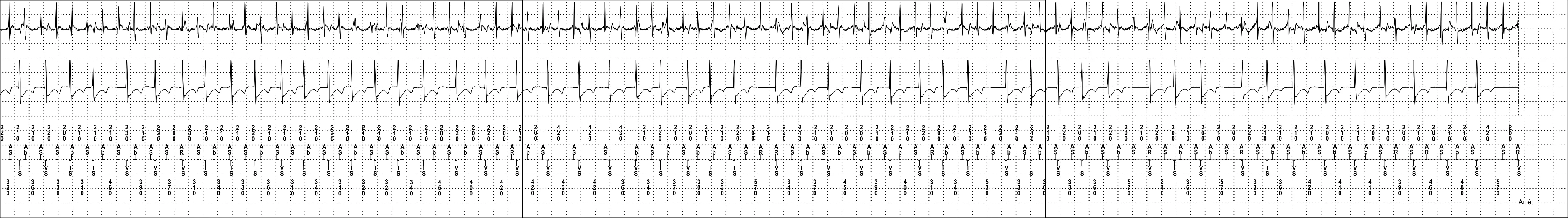 Medtronic ICD electrogram, segment 4 of 4 — Dual-chamber discrimination and atrial detection