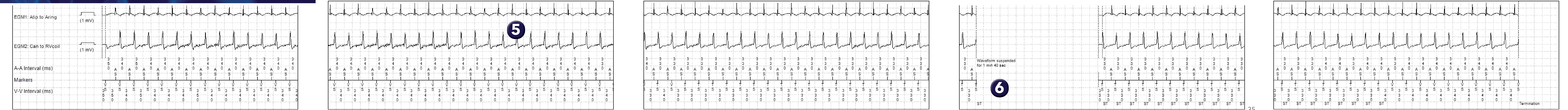 Medtronic ICD electrogram, segment 1 of 1 — Double-chamber discrimination and exertion in a young patient