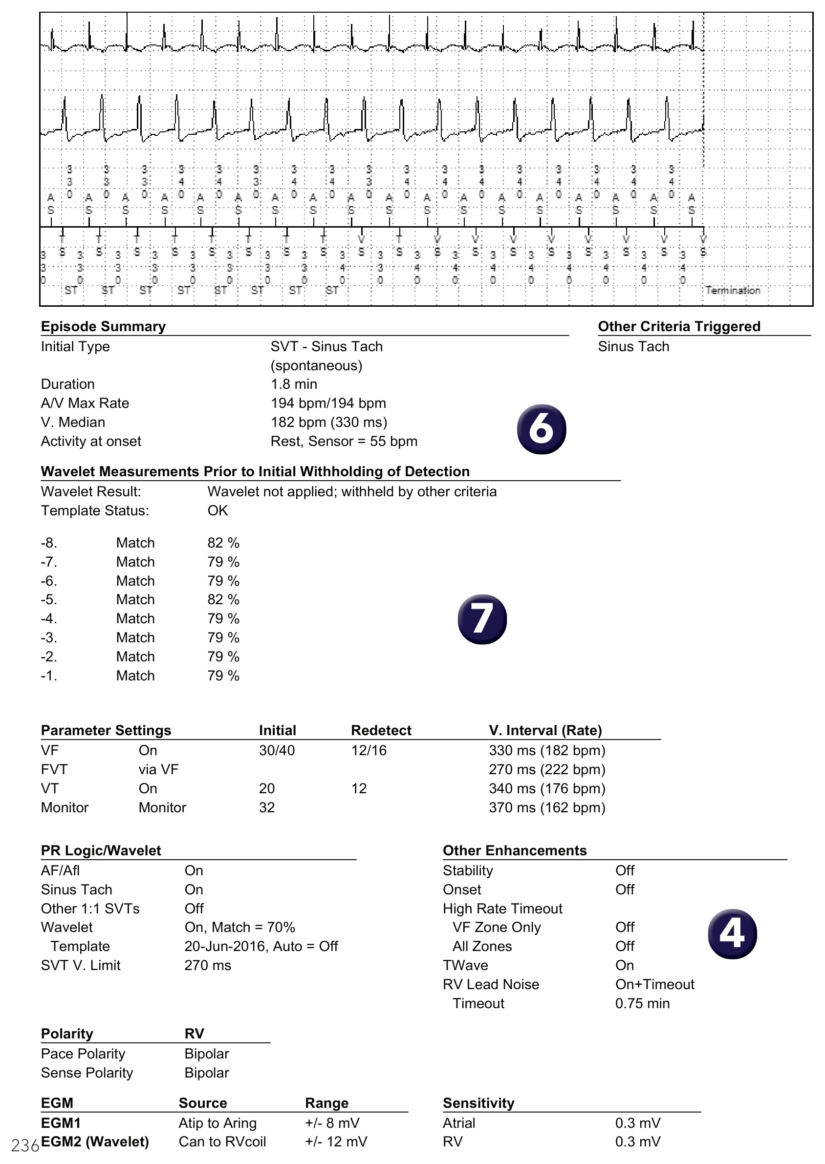 Medtronic ICD electrogram, segment 1 of 1 — Double-chamber discrimination and exertion in a young patient