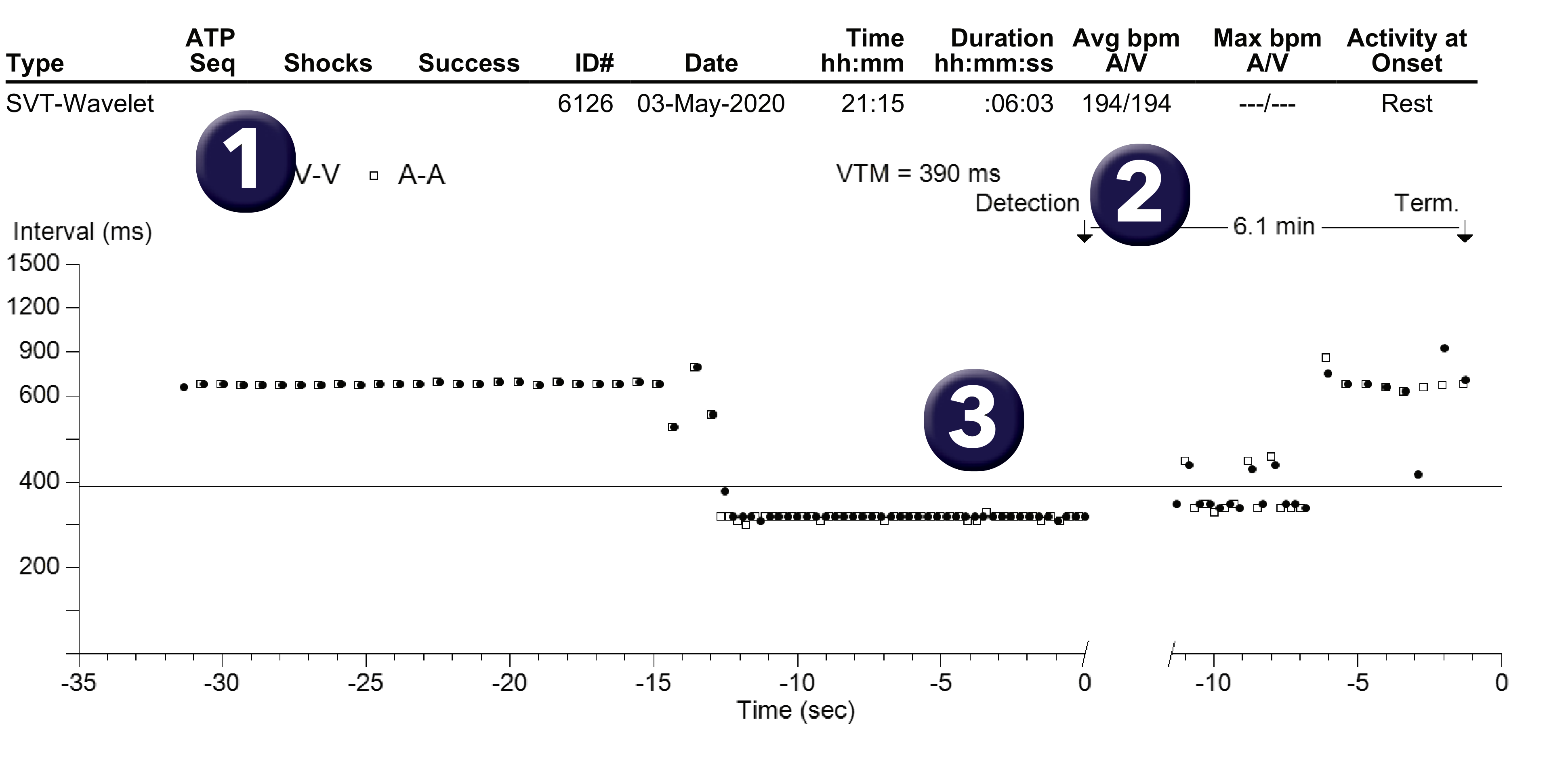 Medtronic ICD electrogram, segment 1 of 1 — 1/1 tachycardia, PR Logic, Wavelet