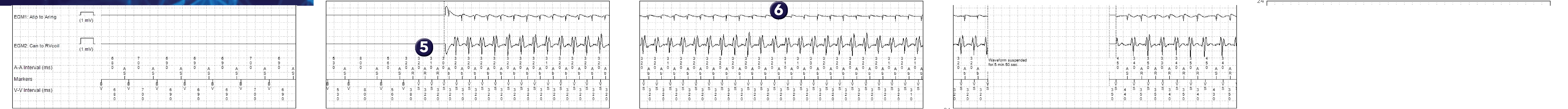 Medtronic ICD electrogram, segment 1 of 2 — 1/1 tachycardia, PR Logic, Wavelet