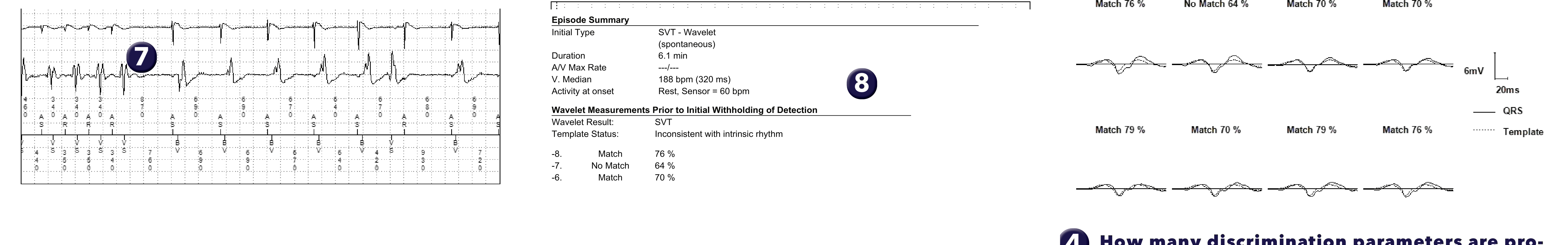Medtronic ICD electrogram, segment 2 of 2 — 1/1 tachycardia, PR Logic, Wavelet