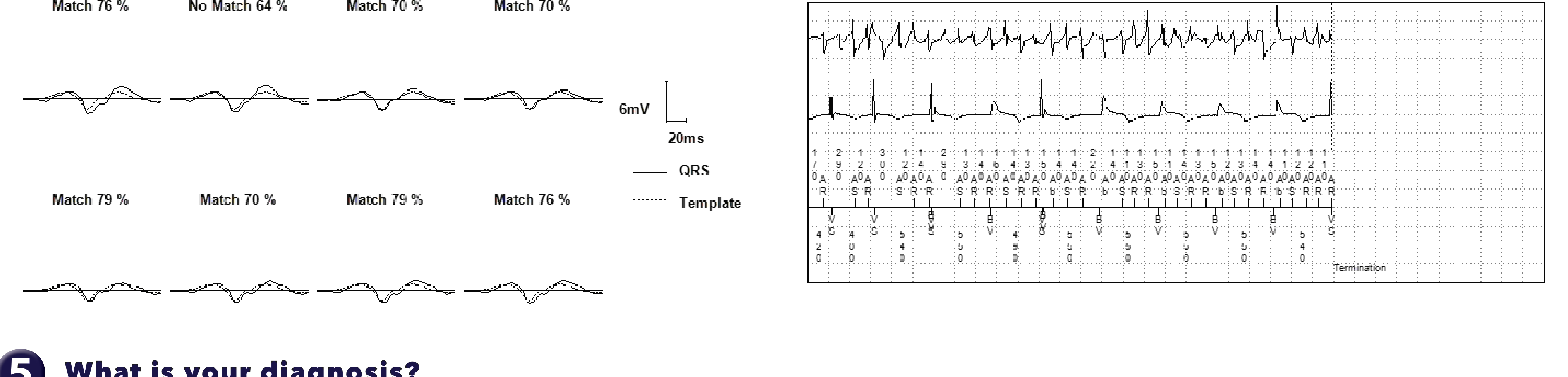 Medtronic ICD electrogram, segment 2 of 2 — PR Logic and conducted AF