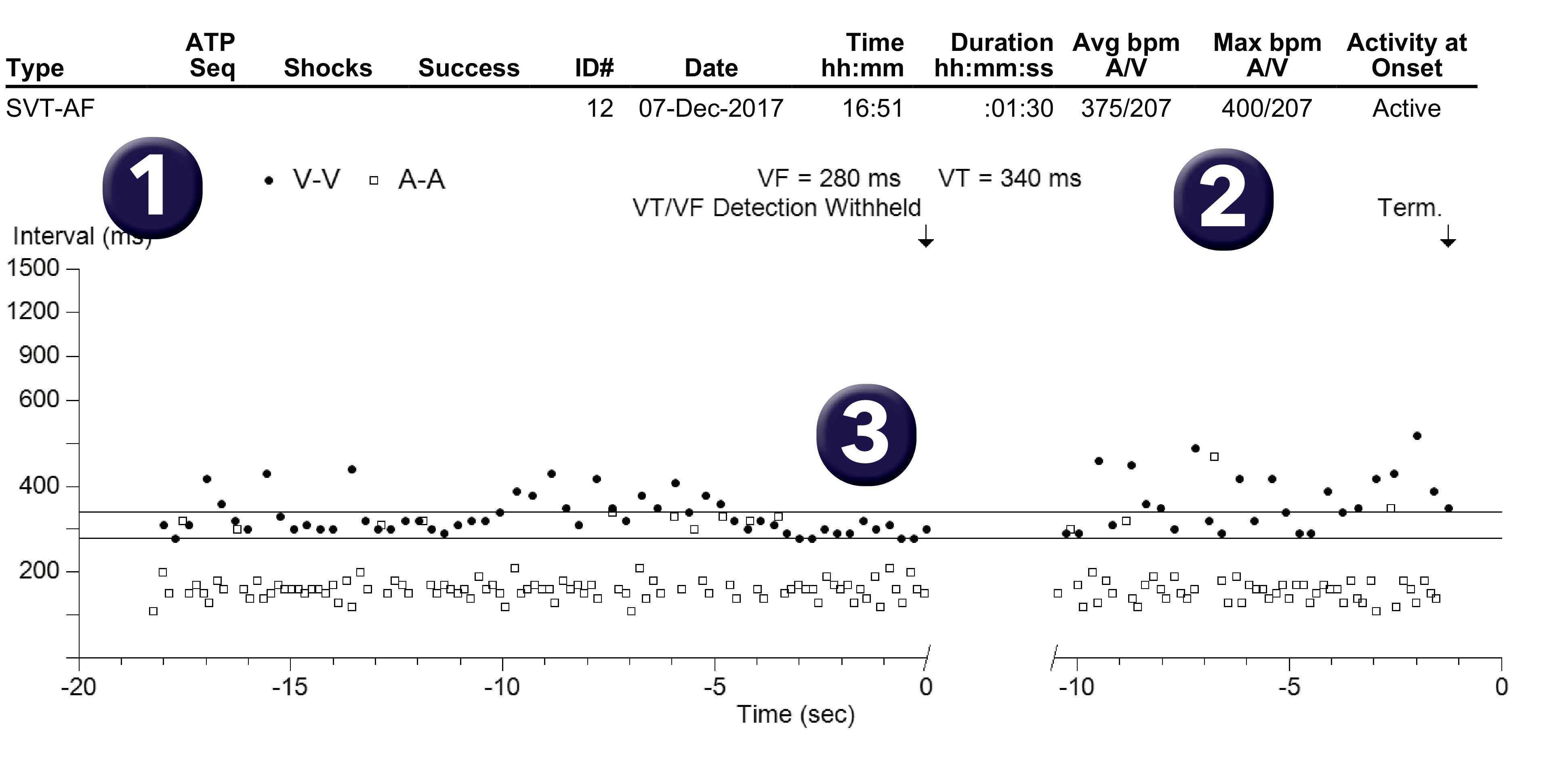 Medtronic ICD electrogram, segment 1 of 1 — Conducted AF, PR Logic and Wavelet