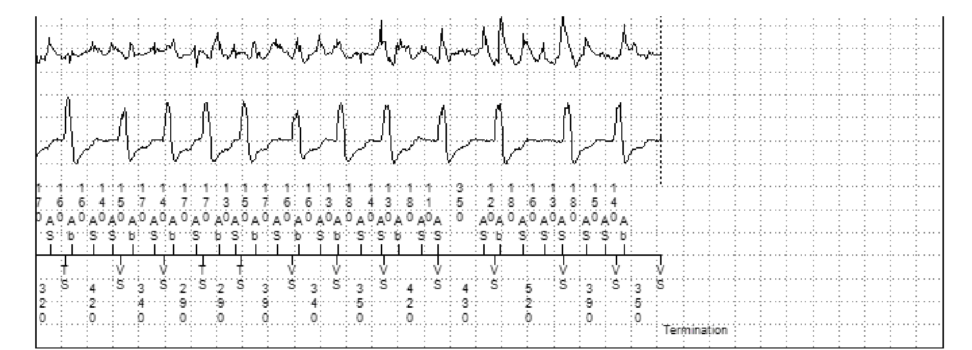 Medtronic ICD electrogram, segment 2 of 2 — Conducted AF, PR Logic and Wavelet