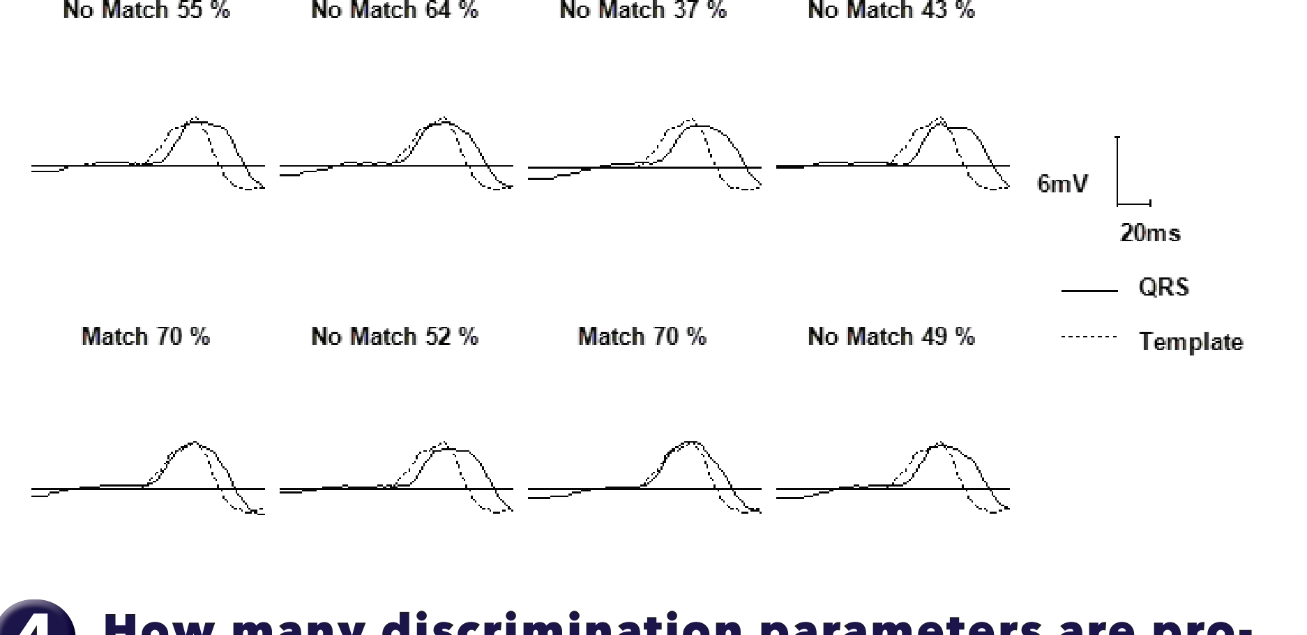 Medtronic ICD electrogram, segment 1 of 2 — Conducted AF, PR Logic and Wavelet