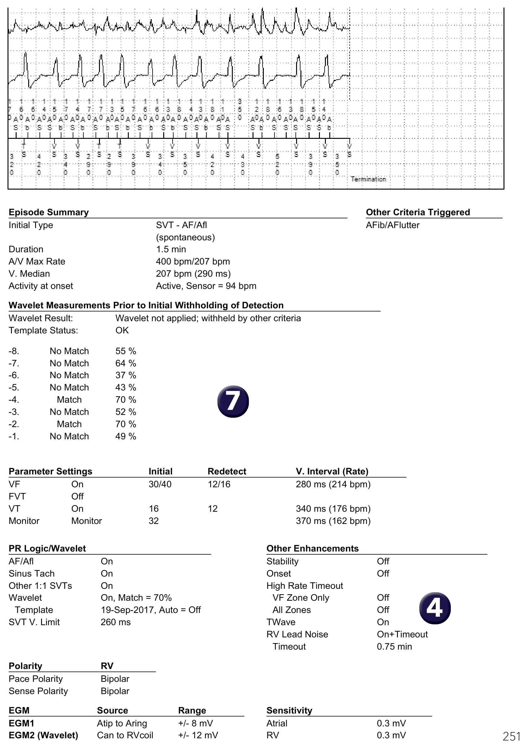 Medtronic ICD electrogram, segment 2 of 2 — Conducted AF, PR Logic and Wavelet