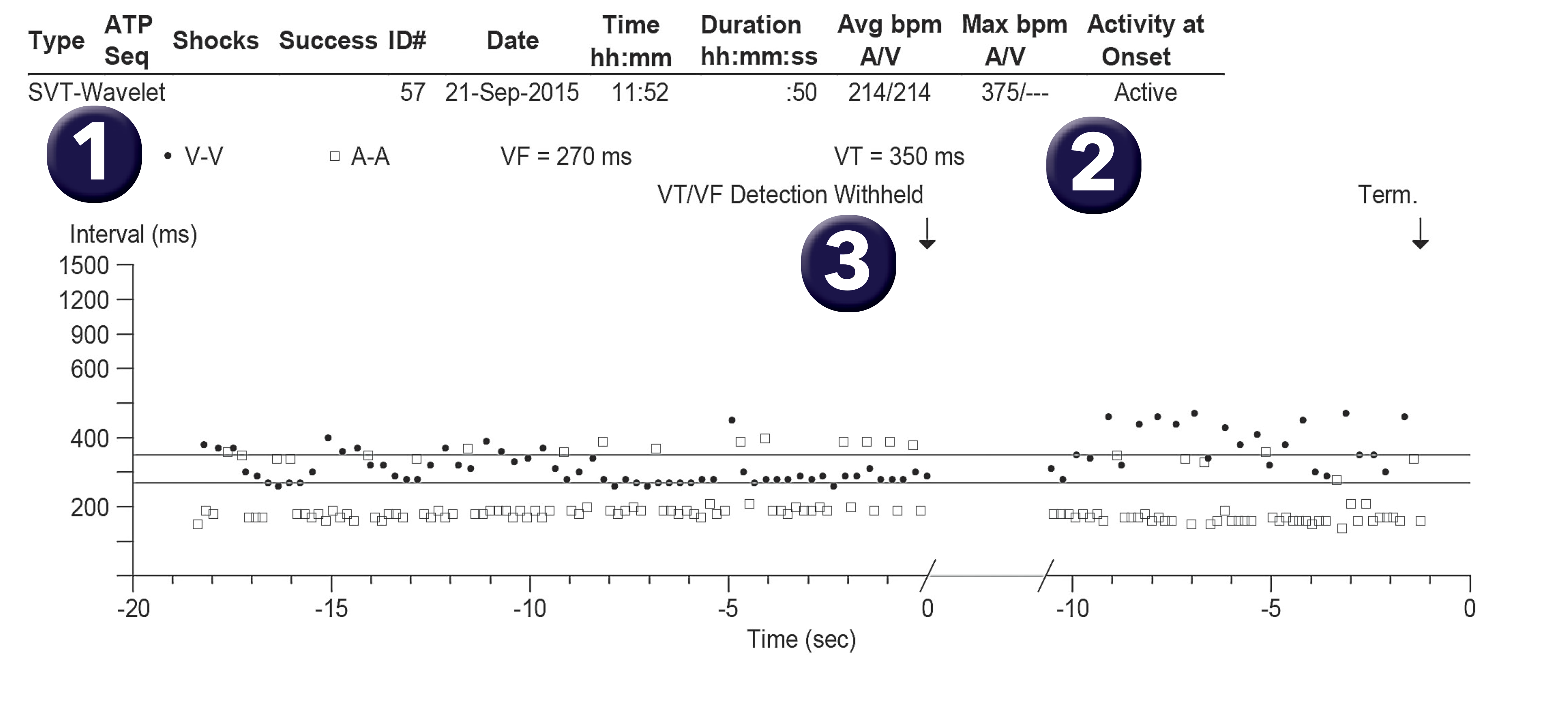 Medtronic ICD electrogram, segment 1 of 1 — AF with regular ventricular response, PR Logic and Wavelet