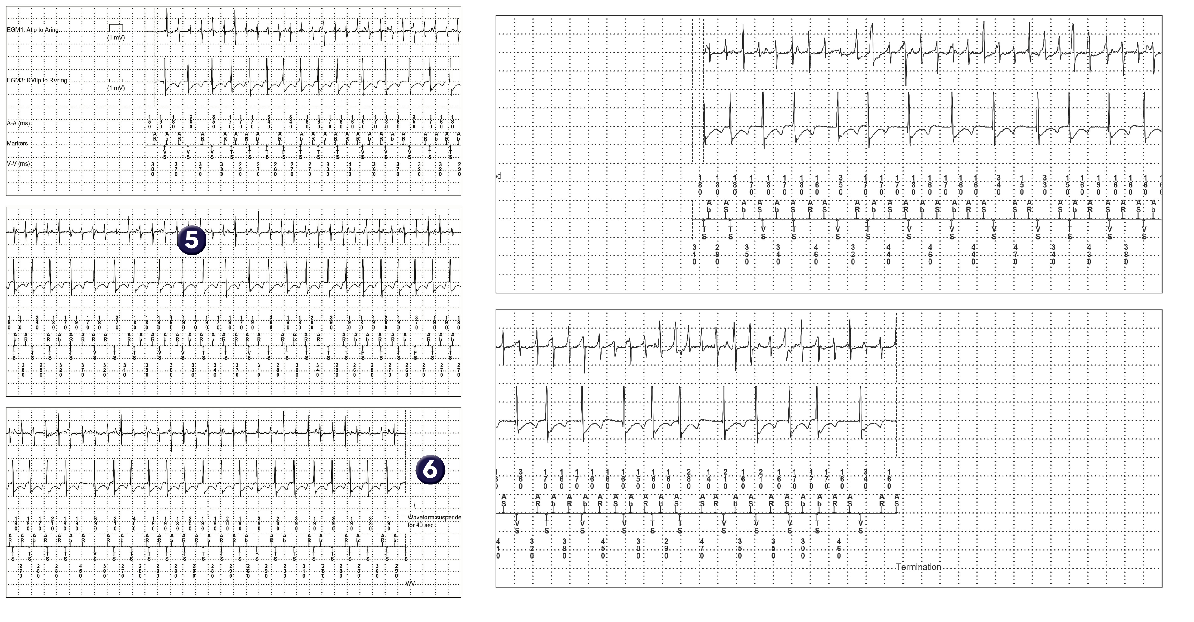 Medtronic ICD electrogram, segment 1 of 1 — AF with regular ventricular response, PR Logic and Wavelet