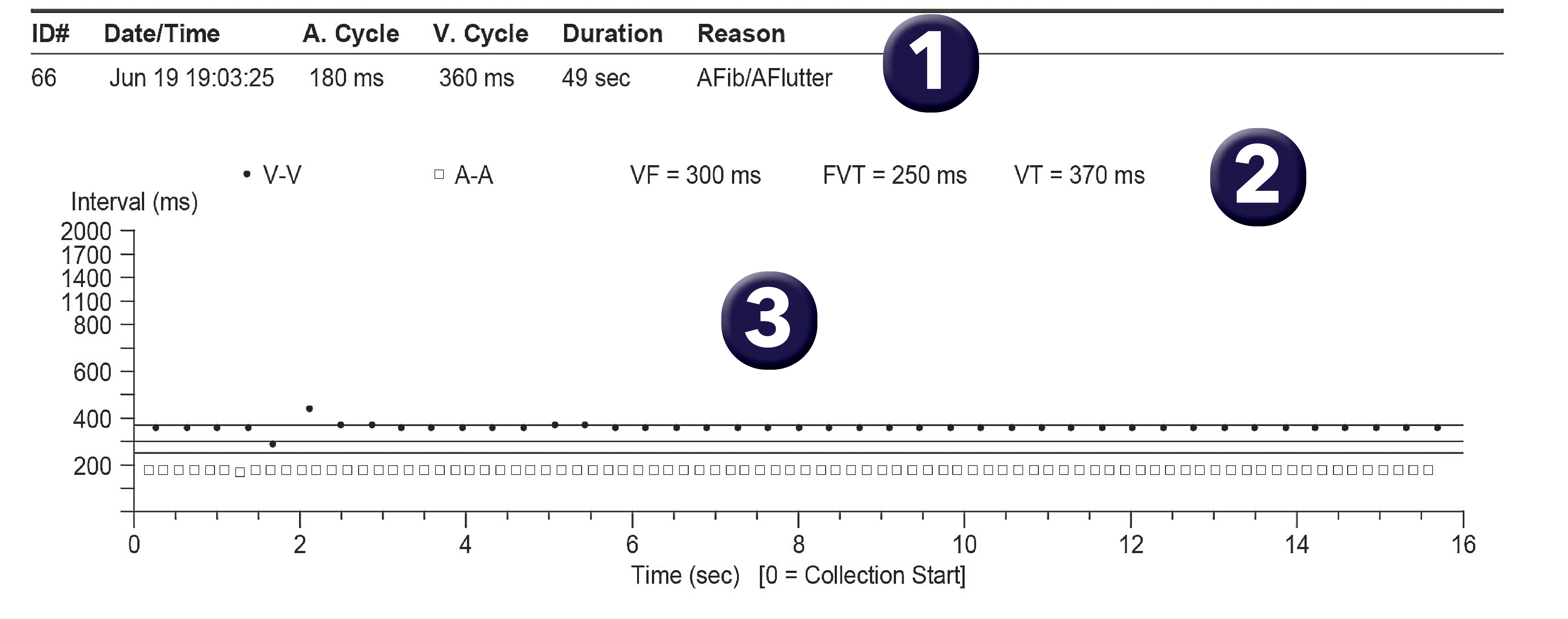 Medtronic ICD electrogram, segment 1 of 1 — PR Logic and atrial flutter