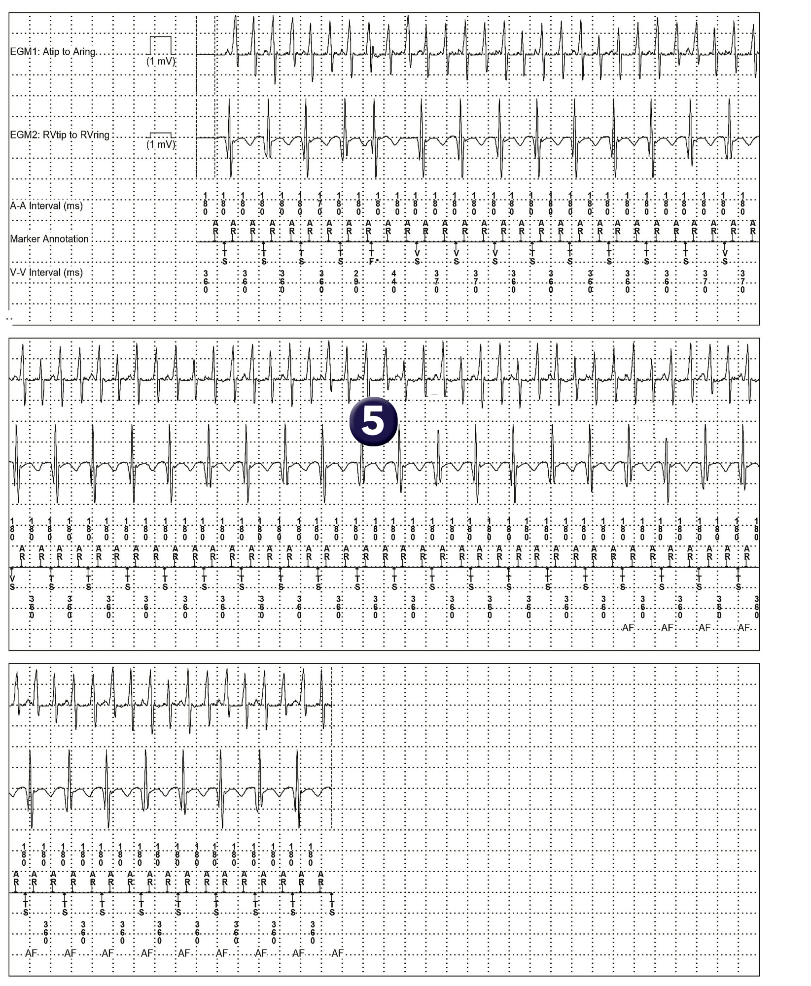 Medtronic ICD electrogram, segment 1 of 1 — PR Logic and atrial flutter
