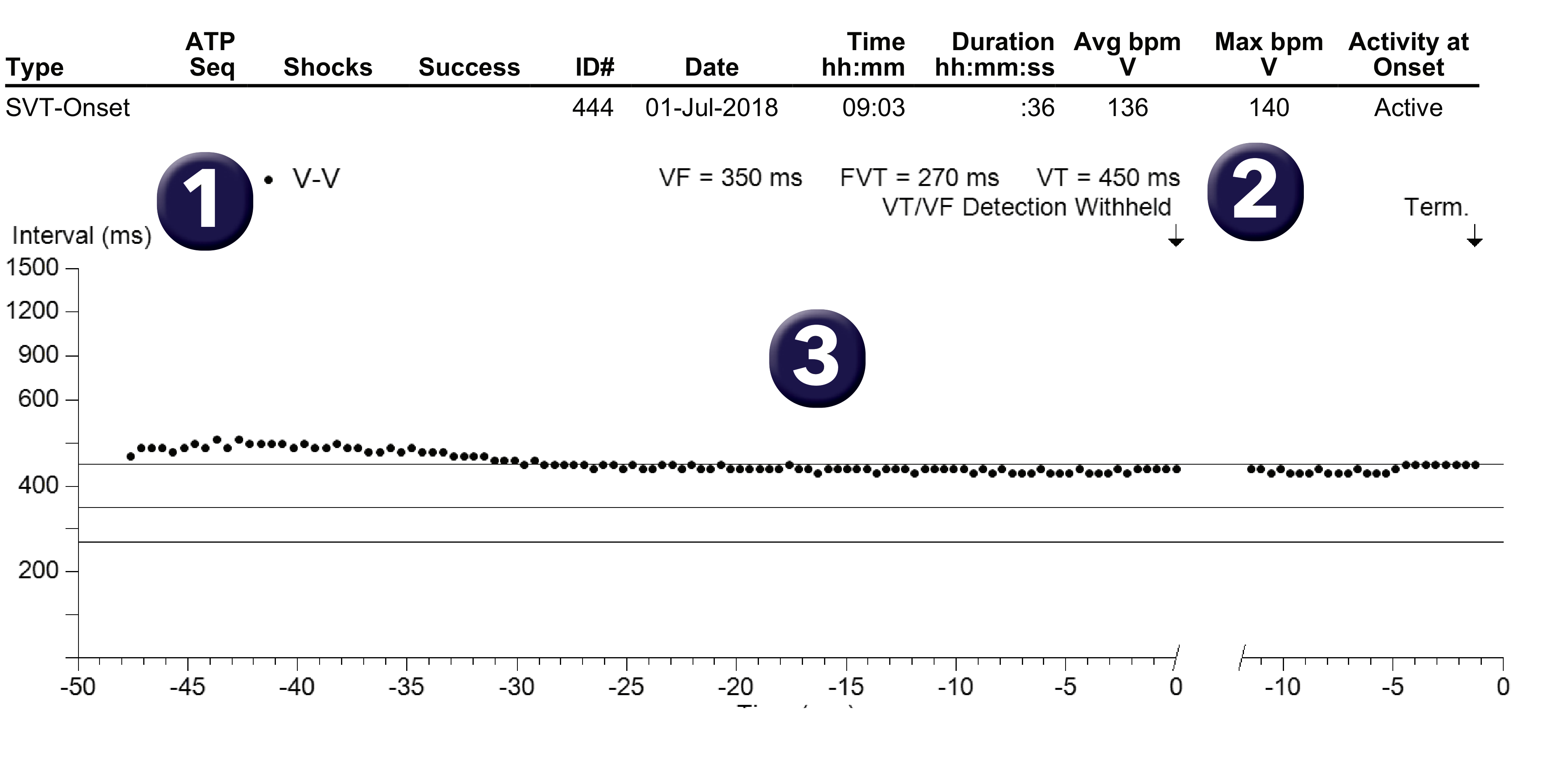 Medtronic ICD electrogram, segment 1 of 1 — Sudden onset criterion and sinus tachycardia