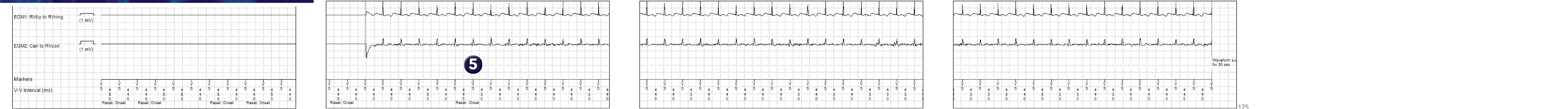Medtronic ICD electrogram, segment 1 of 2 — Sudden onset criterion and sinus tachycardia