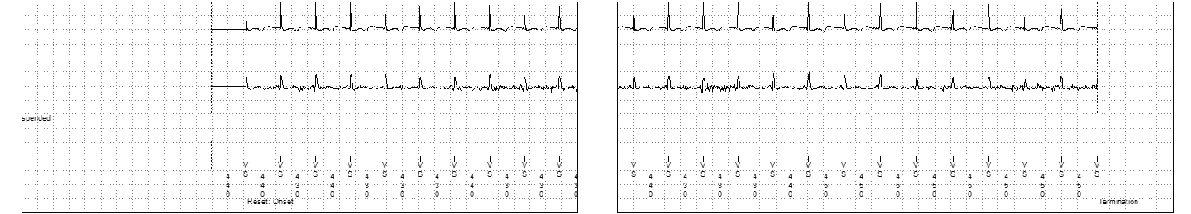 Medtronic ICD electrogram, segment 2 of 2 — Sudden onset criterion and sinus tachycardia