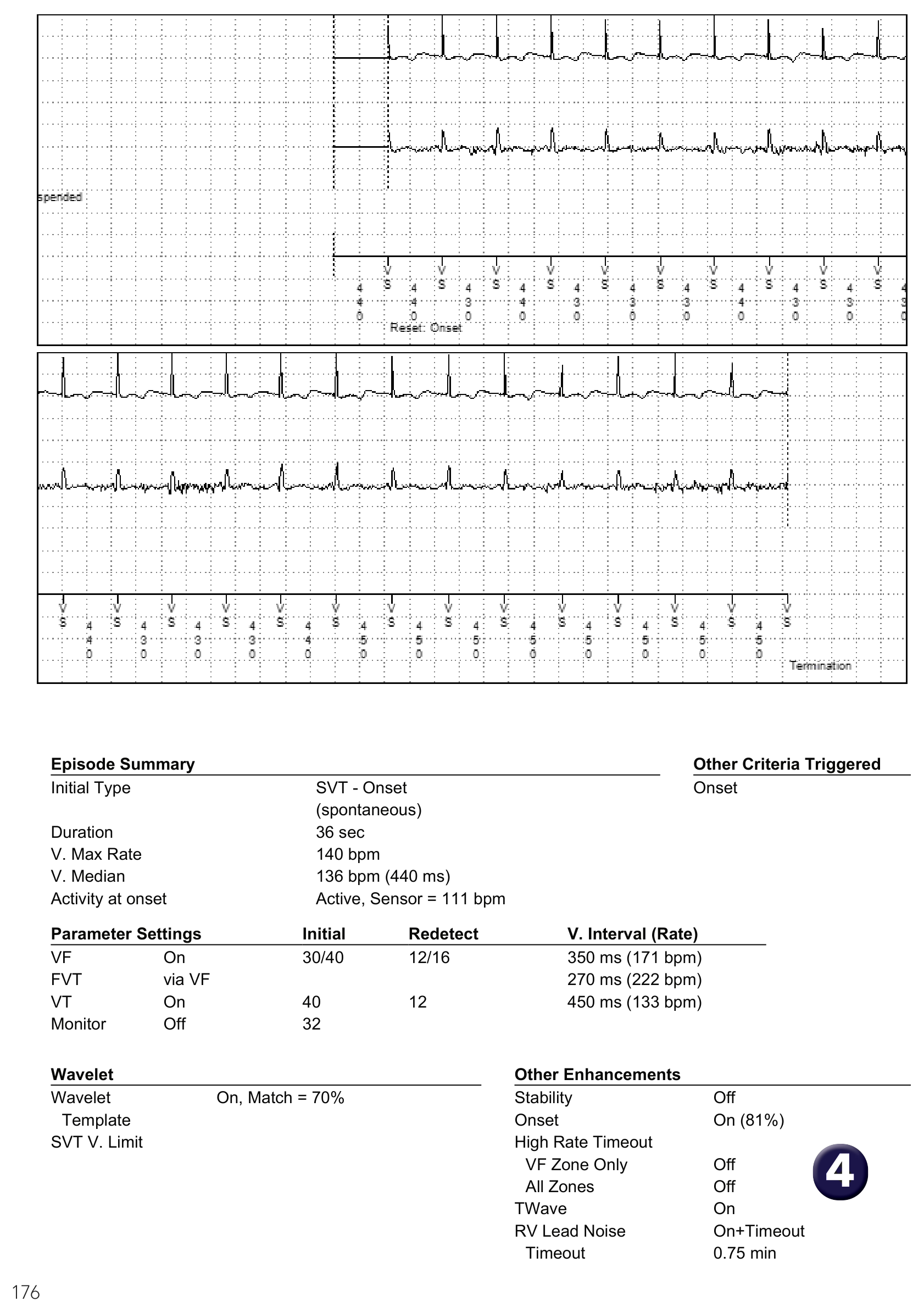 Medtronic ICD electrogram, segment 1 of 1 — Sudden onset criterion and sinus tachycardia