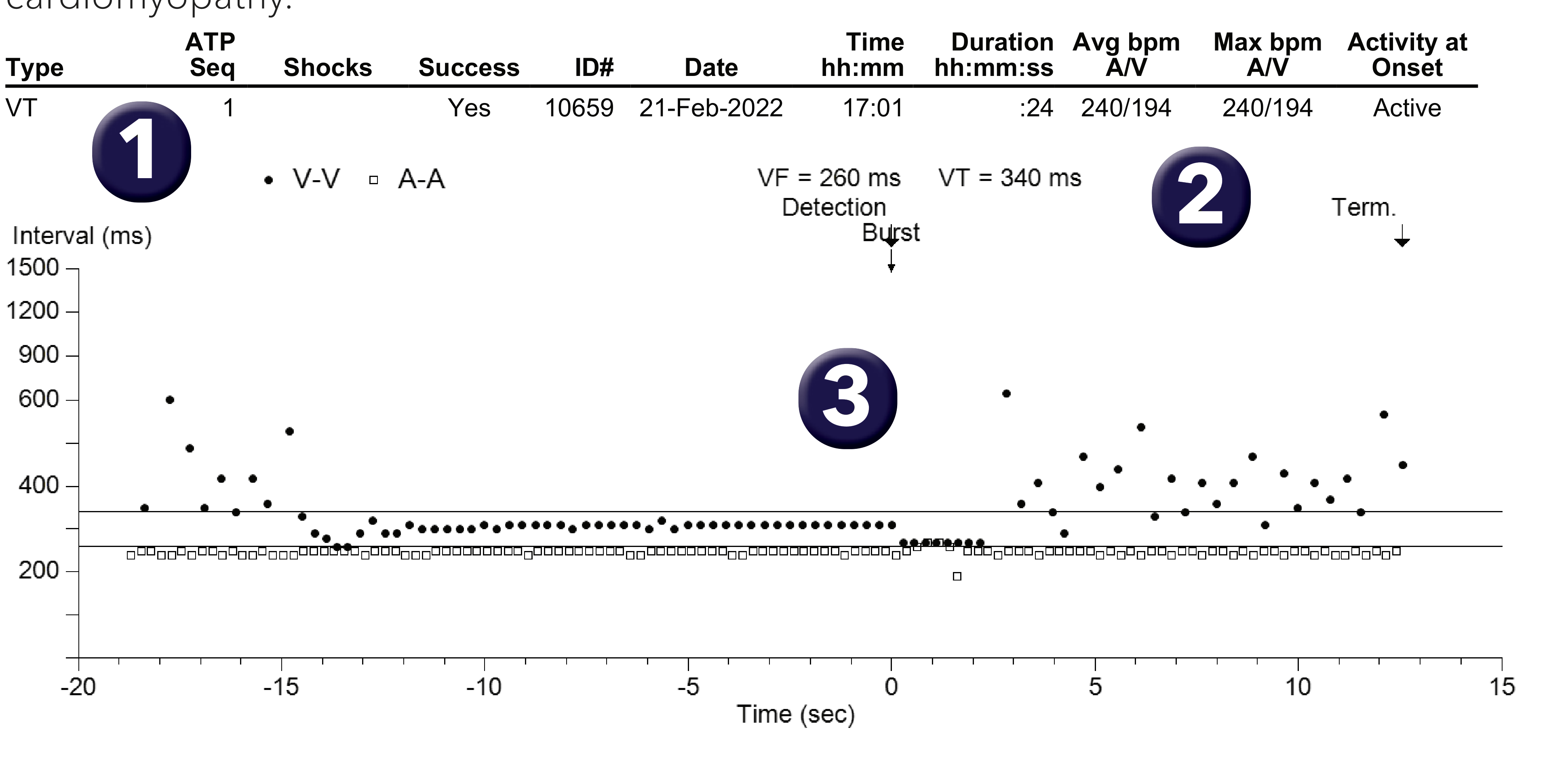 Medtronic ICD electrogram, segment 1 of 1 — Double-chamber discrimination and bi-tachycardia