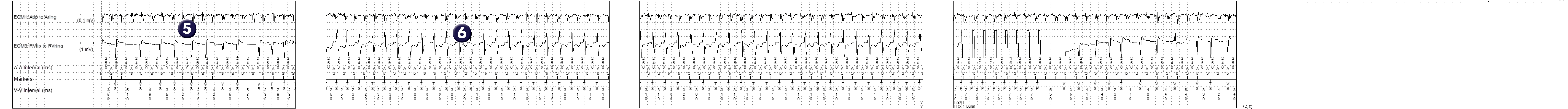 Medtronic ICD electrogram, segment 1 of 2 — Double-chamber discrimination and bi-tachycardia