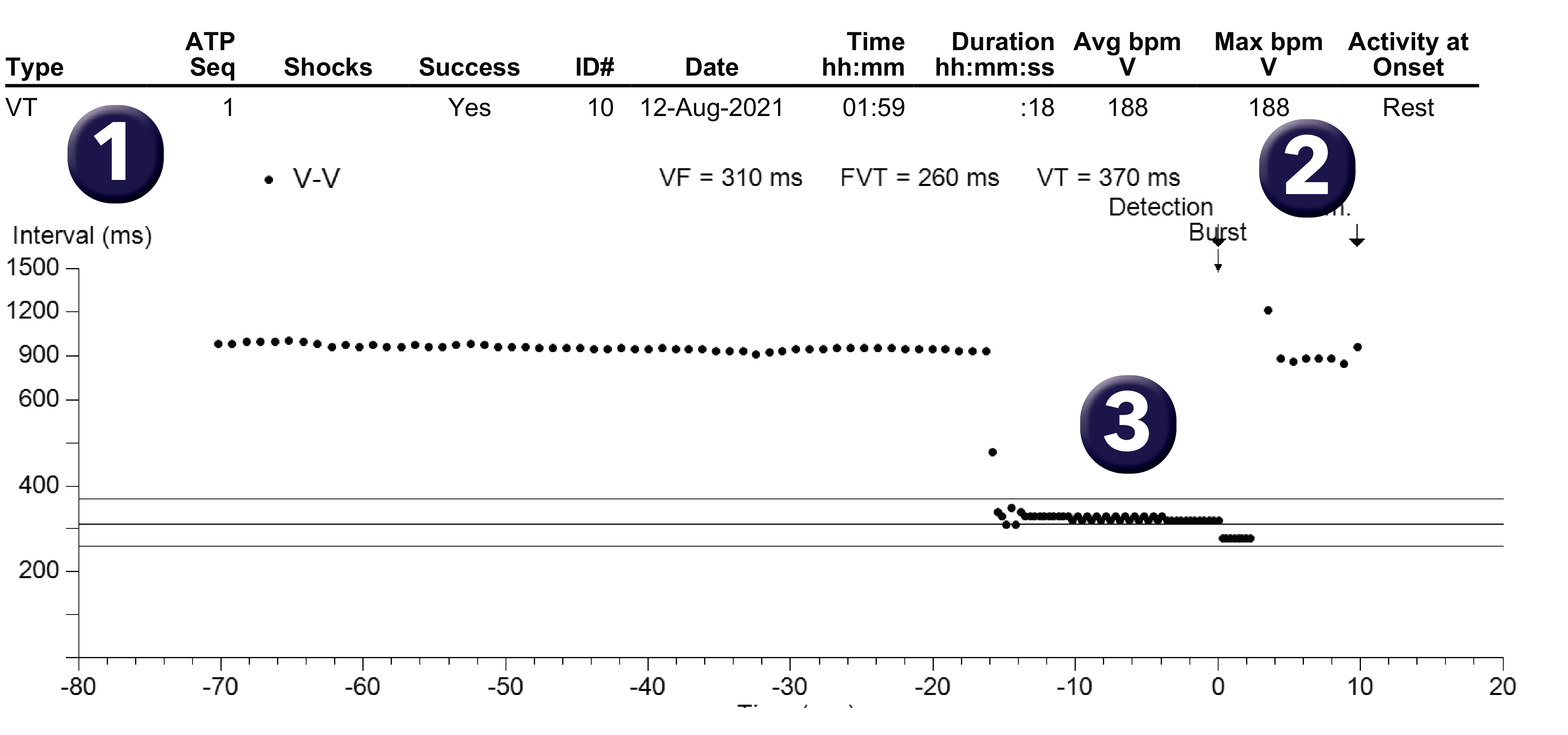 Medtronic ICD electrogram, segment 1 of 1 — Choice of discriminators in a single-chamber defibrillator