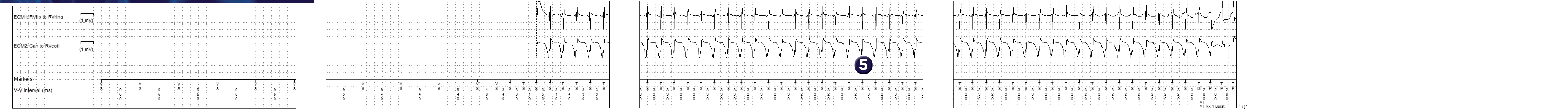 Medtronic ICD electrogram, segment 1 of 2 — Choice of discriminators in a single-chamber defibrillator