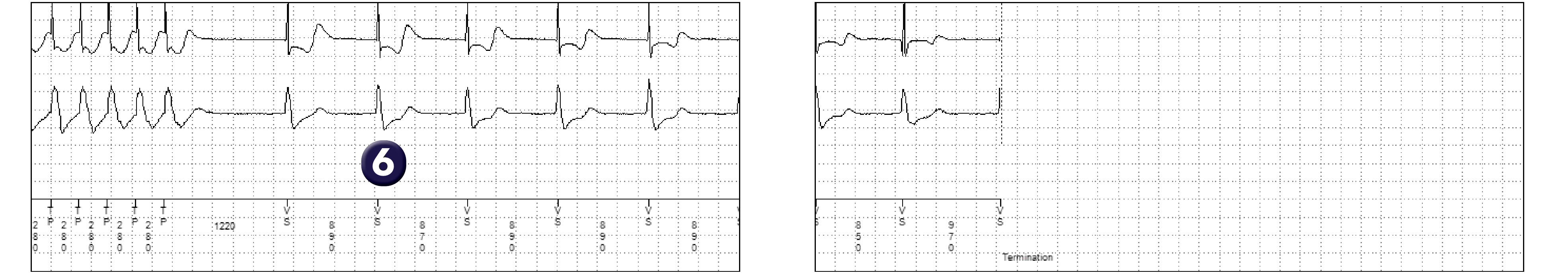 Medtronic ICD electrogram, segment 2 of 2 — Choice of discriminators in a single-chamber defibrillator