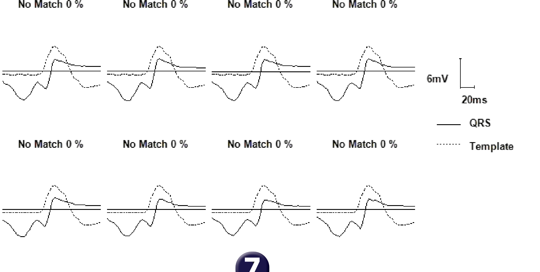 Medtronic ICD electrogram, segment 1 of 2 — Choice of discriminators in a single-chamber defibrillator