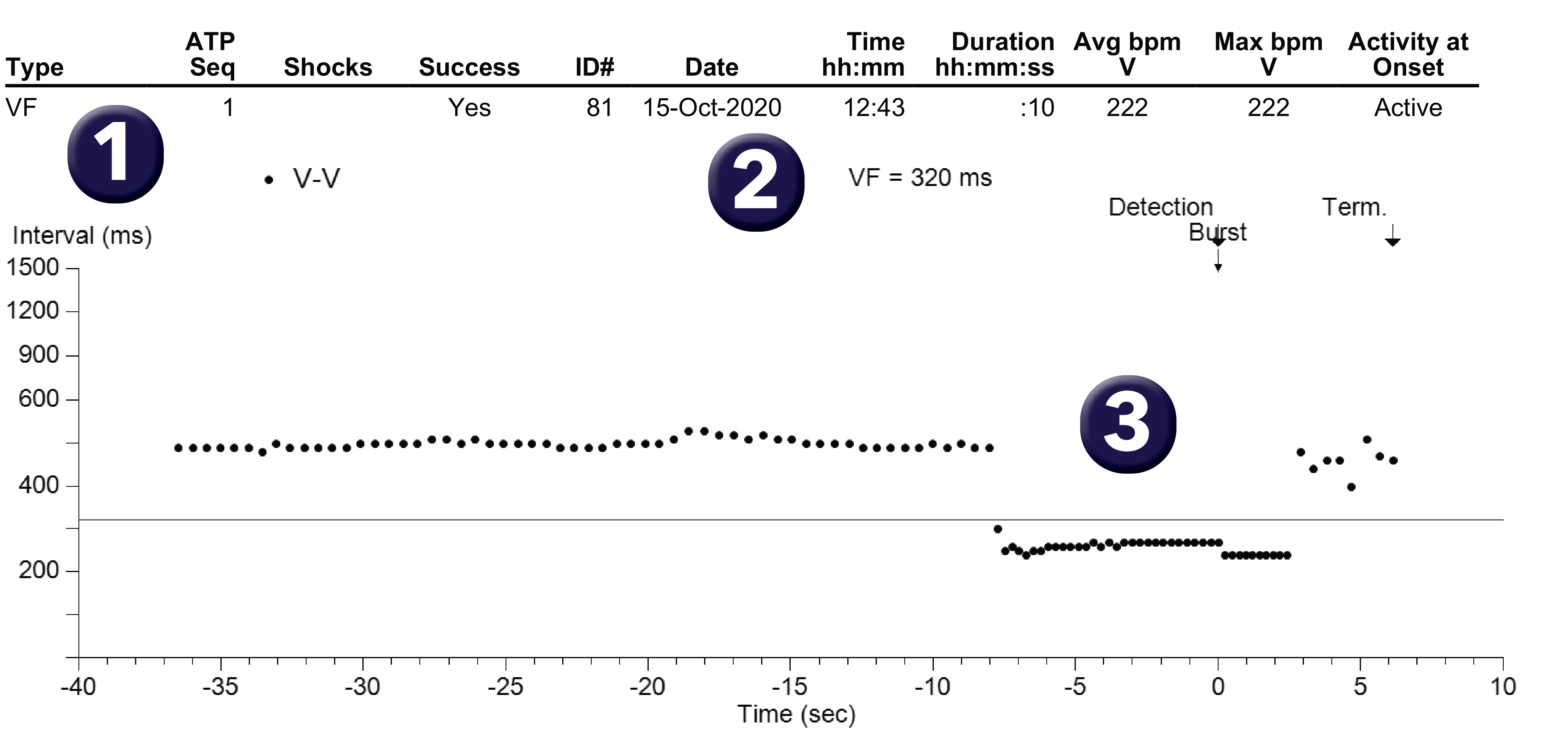 Medtronic ICD electrogram, segment 1 of 1 — Single-chamber defibrillator and new recommendations