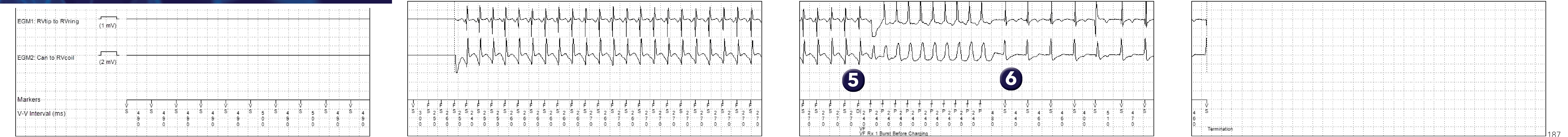 Medtronic ICD electrogram, segment 1 of 1 — Single-chamber defibrillator and new recommendations