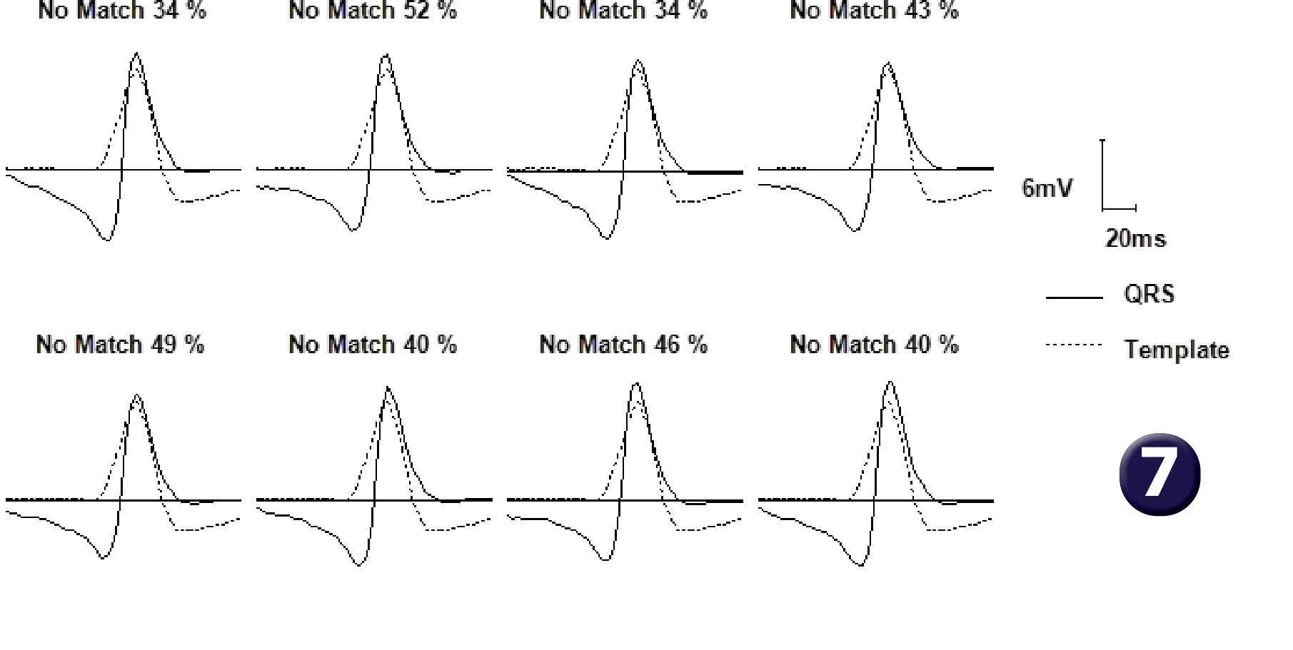 Medtronic ICD electrogram, segment 1 of 2 — Single-chamber defibrillator and new recommendations
